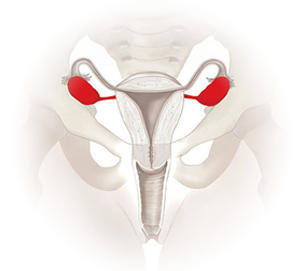 ovarian cancer logo